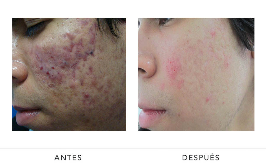 AD-acne2