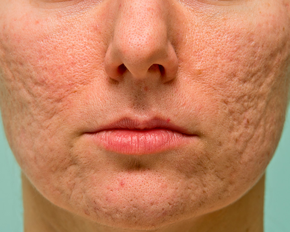 laser-cicatrices.acne