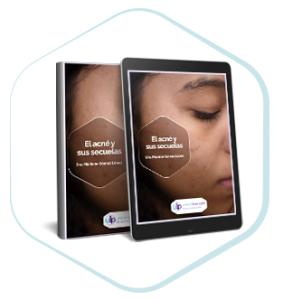 post e book acne 283x300